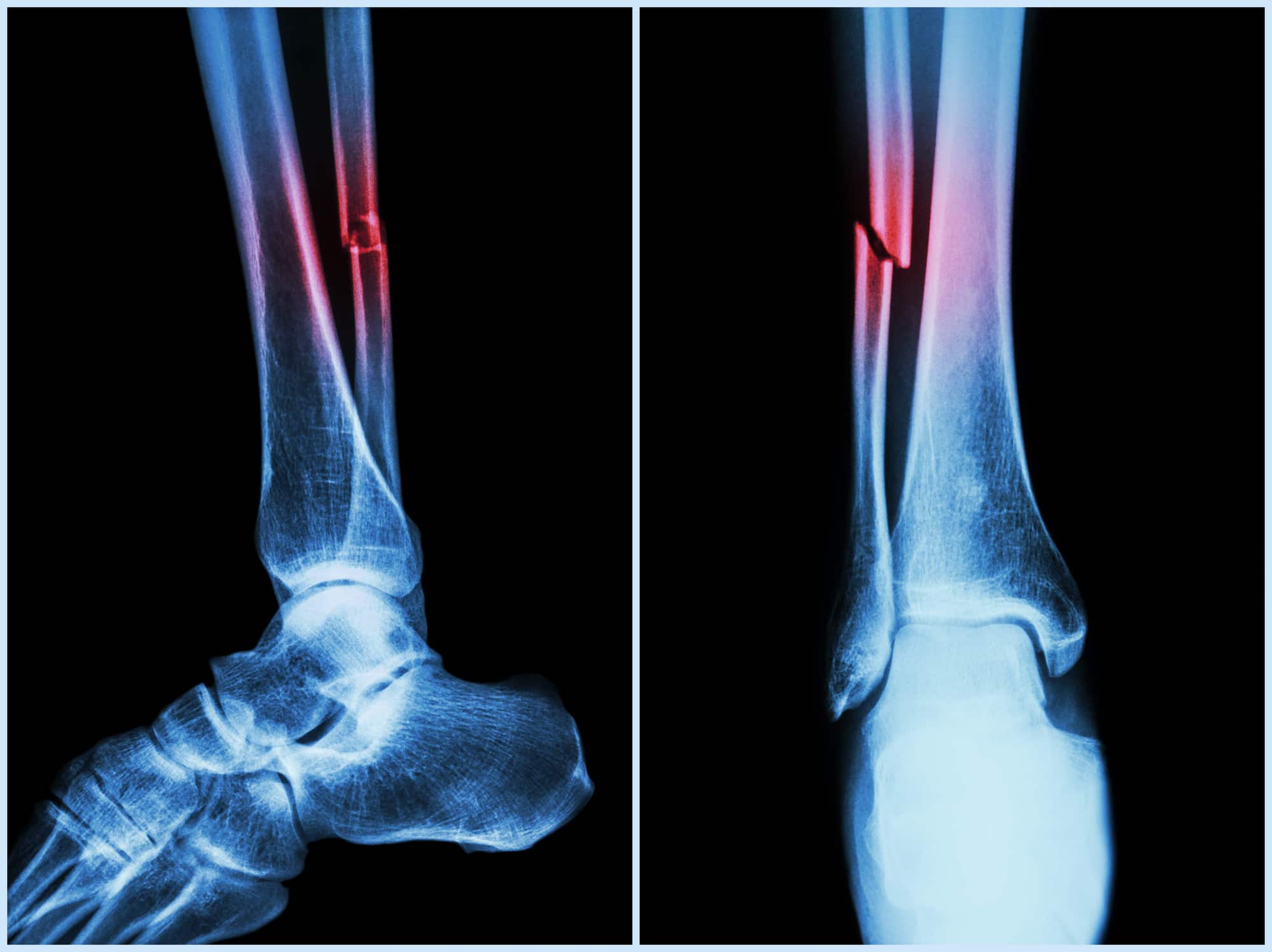 ankle fracture | Tumblr